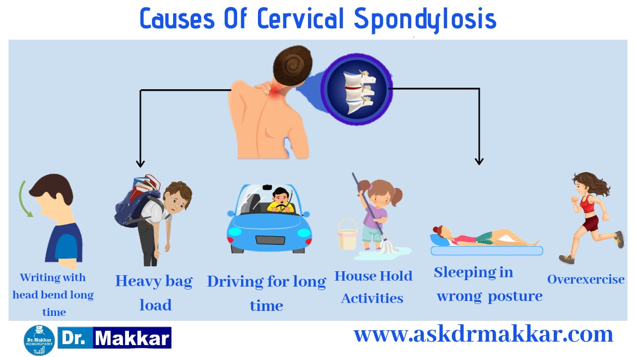 Causes of Cervical Spondylosis || सर्वाइकल स्पोंडिलोसिस के कारण